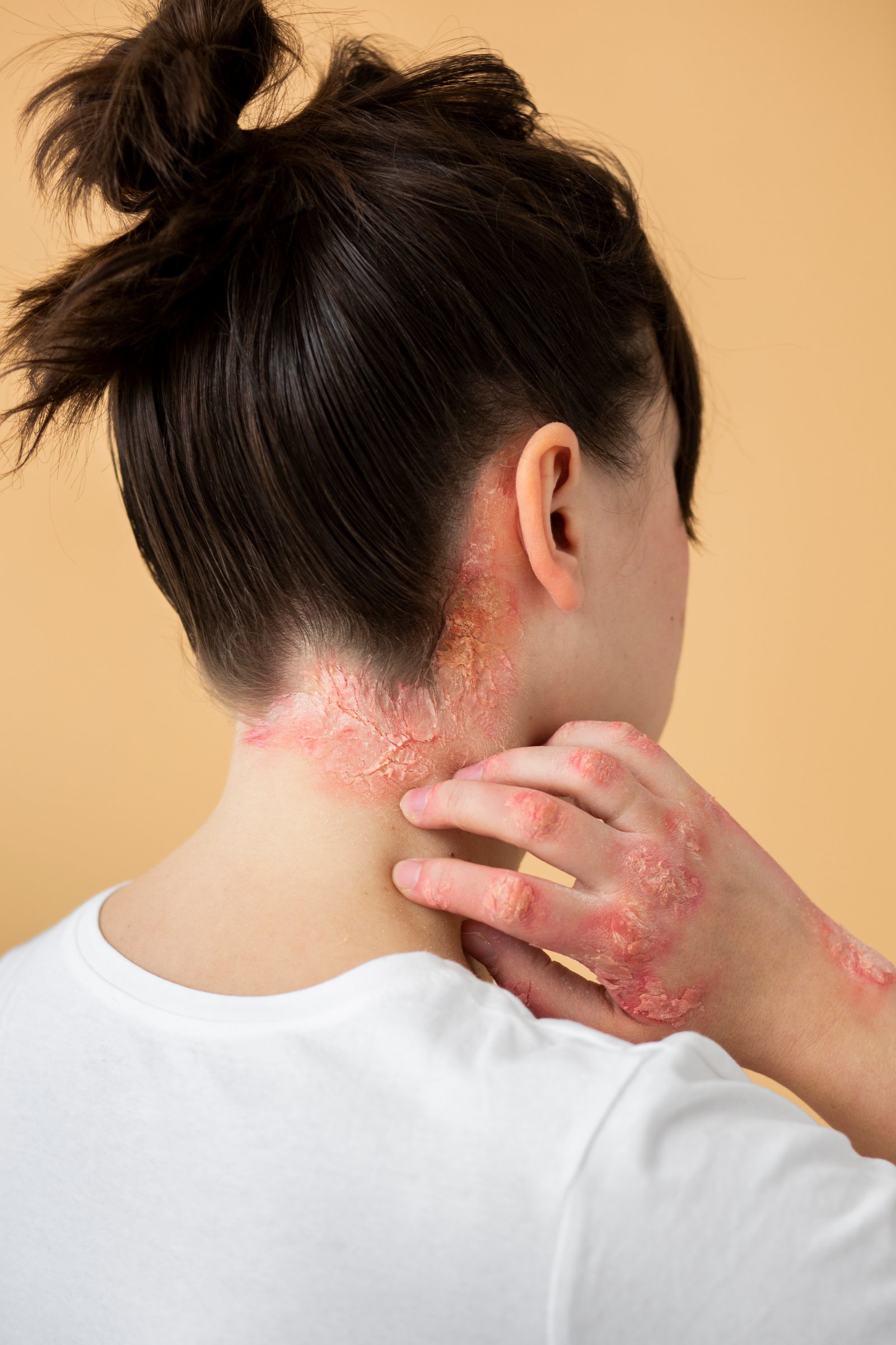 Psoriasis